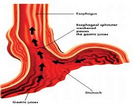 Say Goodbye to Stomach Reflux: Natural Herbal Remedies That Work