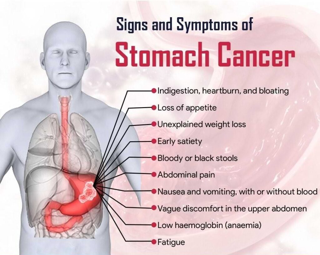 Stomach Cancer from Meat Products: Facts and Figures Stomach Cancer from Meat Products: Facts and Figures